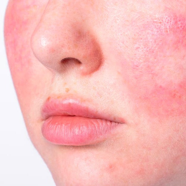 Redness / Rosacea